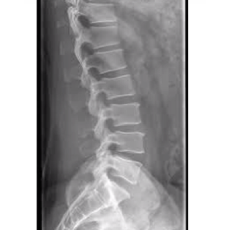 Buy X Ray Ls Spine Lat View Get Price For Lab Equipment